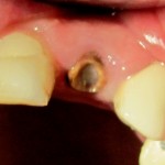 исходная ситуация - перелом корня бокового резца