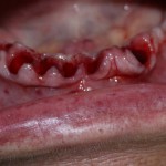 из-за осложнений периодонтита удалены все зубы нижней челюсти