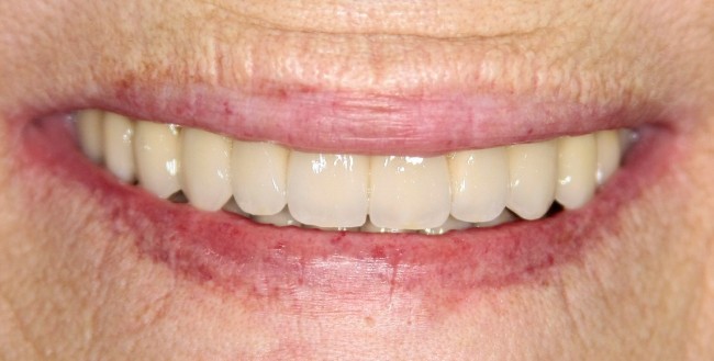 Пациентка очень довольна!