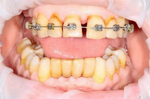 Почти начало лечения. Месяц назад удалены нижние резцы, начато ортодонтическое лечение