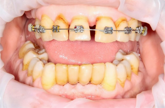 Почти начало лечения. Месяц назад удалены нижние резцы, начато ортодонтическое лечение