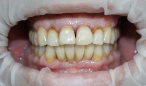 Через 2 месяца после окончательного протезирования.