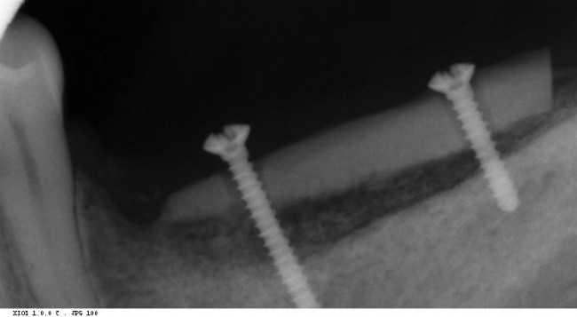 3 месяца после остеопластики