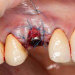 немедленная имплантация: одновременно с установкой импланта проводится пластика и формирование десны: