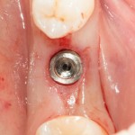 установка импланта