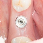 клиническая картина через месяц после имплантации