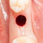 круговой разрез мукотомом и подготовка лунки под имплантат