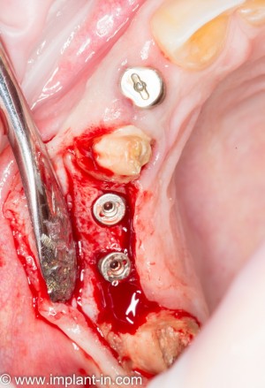 результат через 3 месяца после остеопластики - утраченные объемы кости восстановлены, импланты интегрированы.