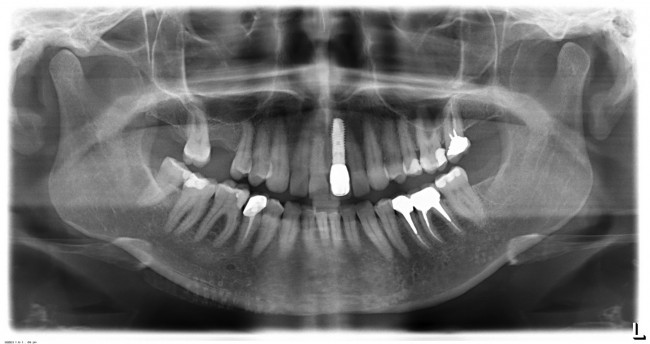Ортопантомография служит тем же целям, что и прицельные снимки, но более масштабно