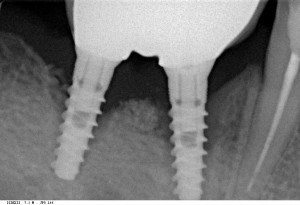 импланты стоят, коронки на месте. Но можно ли считать такую работу качественной?