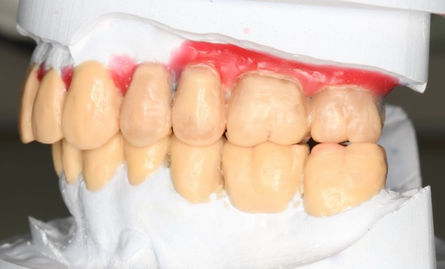 восковое моделирование помогает понять, как будет выглядеть конечная протетическая конструкция