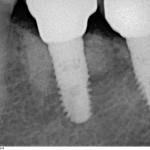 Контрольный снимок сделан на профилактическом осмотре через два года после операции имплантации. Никаких проблем нет, резорбция костной ткани в области имплантов отсутствует