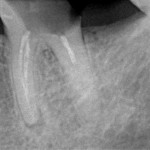 изначальный снимок до лечения. Мы планируем удаление 36 зуба и одномоментную имплантацию в его области, установку импланта в область 37 зуба, удаление зуба мудрости (38). И все это - за одну операцию!