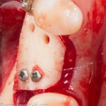 костный блок подготовлен к адаптации "на месте"