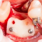 винты расставлены широко, чтобы не мешать установке импланта