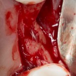 Изначальная клиническая ситуация: существенная утрата объема альвеолярного гребня. Необходимы остеопластика и синуслифтинг