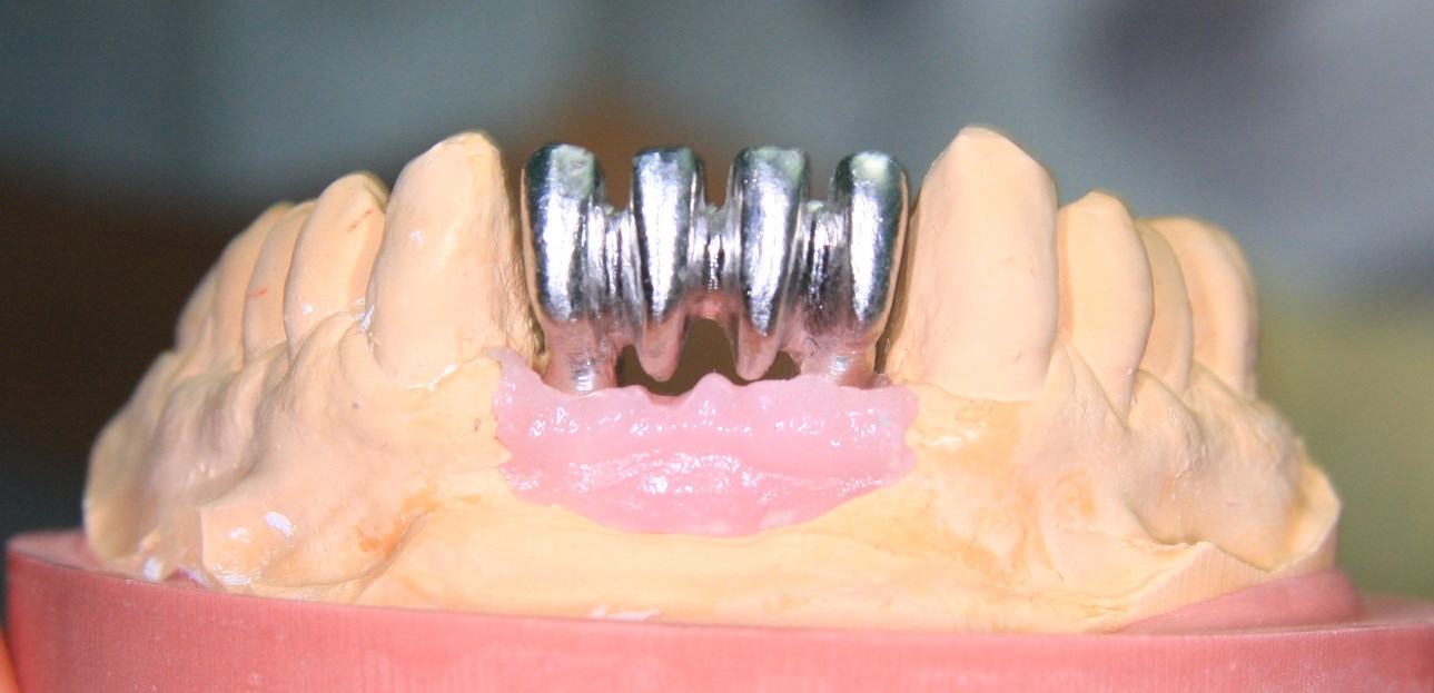 Имплантация: быстро, качественно, недорого. Возможно ли такое?