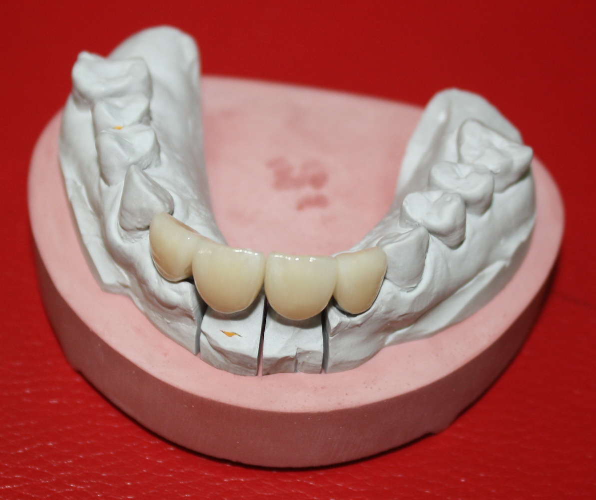 Мои работы: Остеопластика-имплантация-протезирование. Ничего сложного, простая последовательность действий.