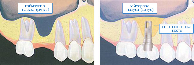 Остеопластика, «наращивание костной ткани» — индивидуальный подход в каждом случае. Часть первая.