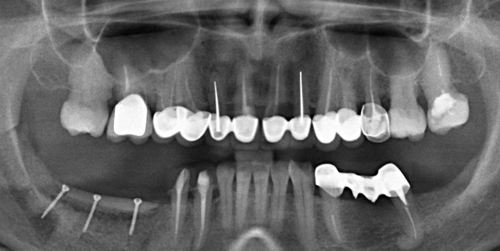 Остеопластика — всего одна операция.