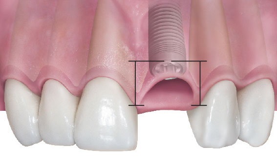 Чем хороша немедленная имплантация?