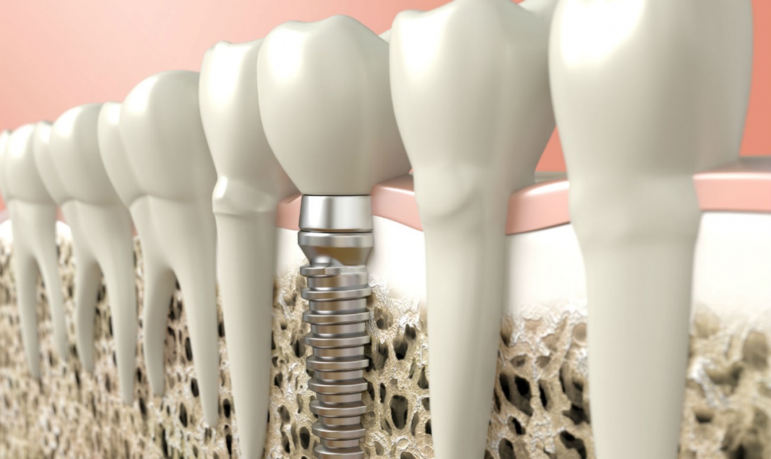 Немедленная имплантация: от&nbsp;старта до&nbsp;финиша. Или&nbsp;как&nbsp;получить качественный результат лечения с&nbsp;минимальными усилиями