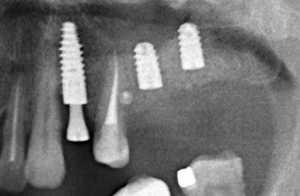 Имплантация и остеопластика: вместе или врозь? Часть II плюс Ankylos, плюс Geistlich