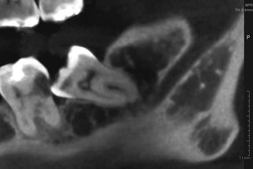 Почему нужно удалять зубы мудрости и не ждать, пока они приведут к проблемам?