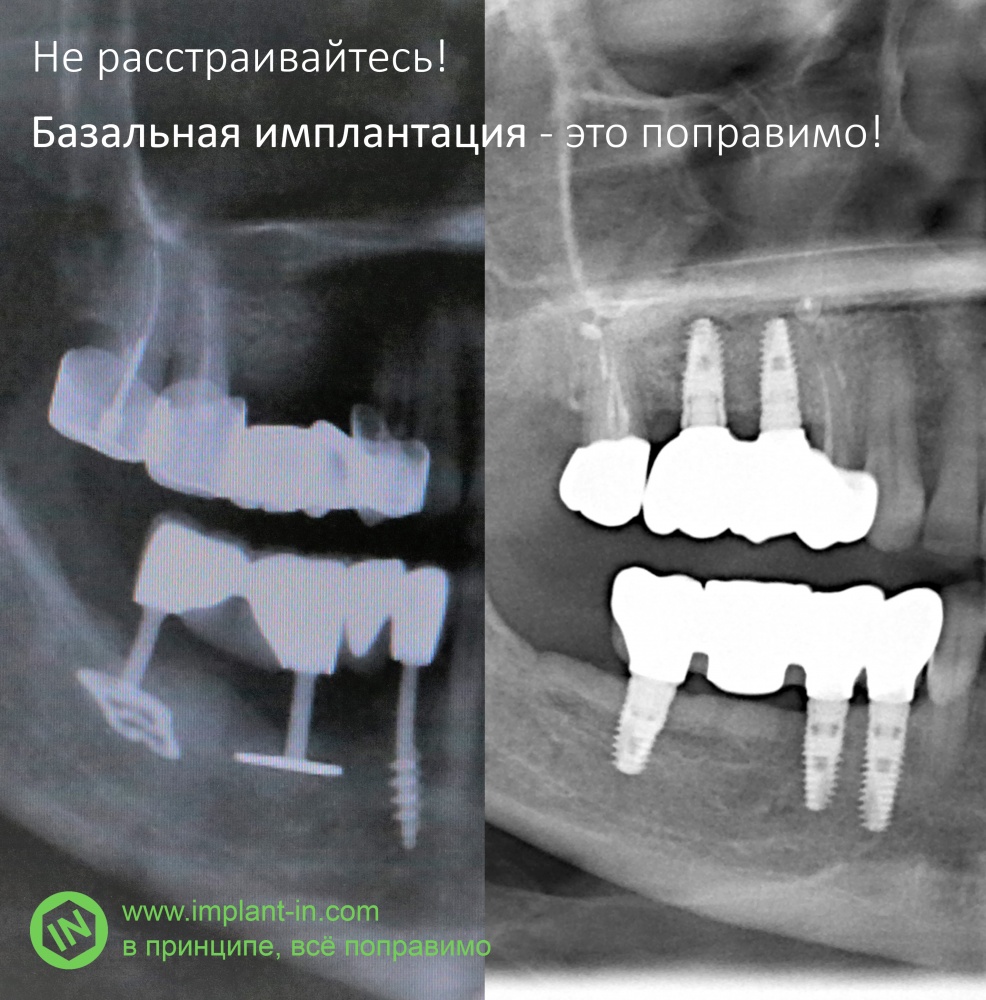 Не нужно расстраиваться! Базальная имплантация — это поправимо.