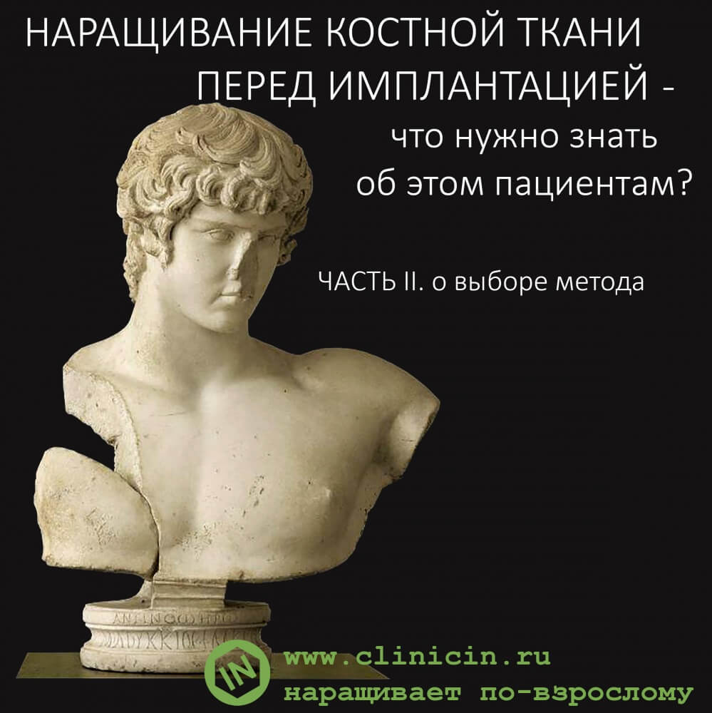 Наращивание костной ткани перед имплантацией — что нужно знать об этом пациентам? Часть II
