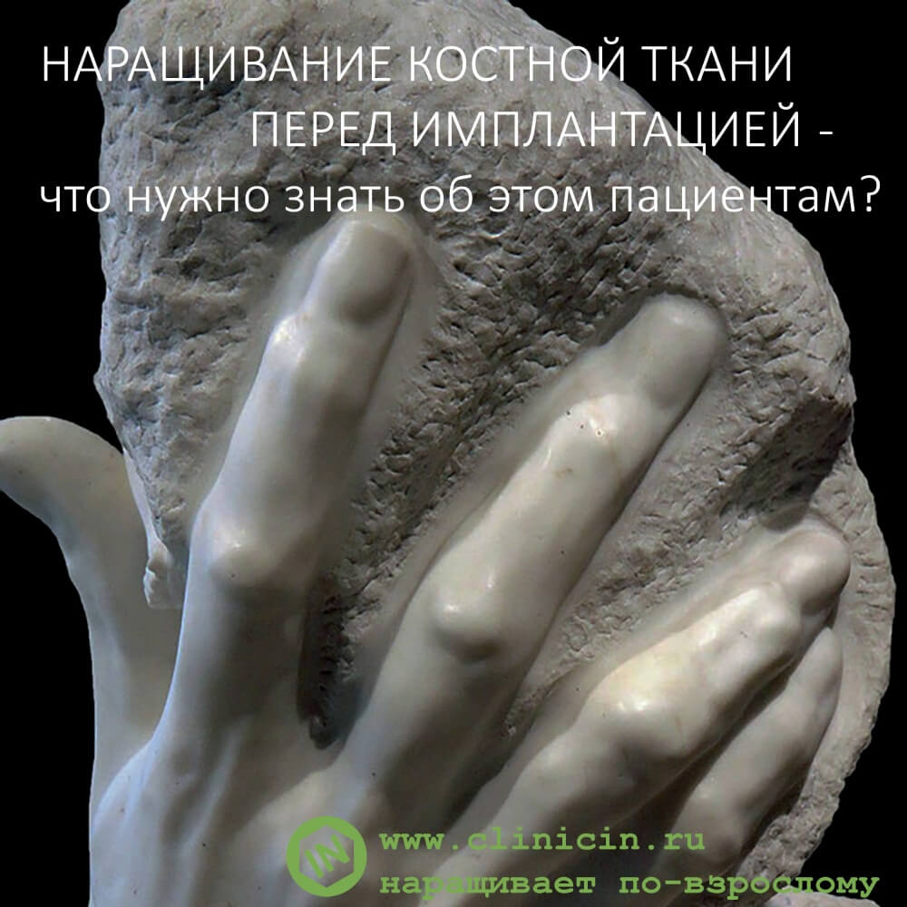Наращивание костной ткани перед имплантацией — что нужно знать об этом пациентам?