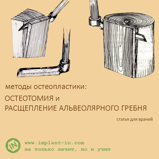 Методы остеопластики: остеотомия и расщепление альвеолярного гребня