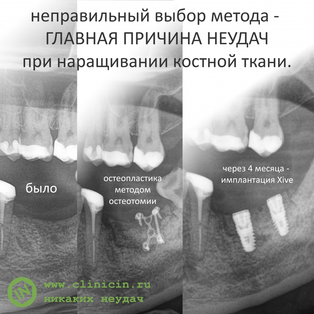 О выборе метода наращивания костной ткани и неудачных результатах