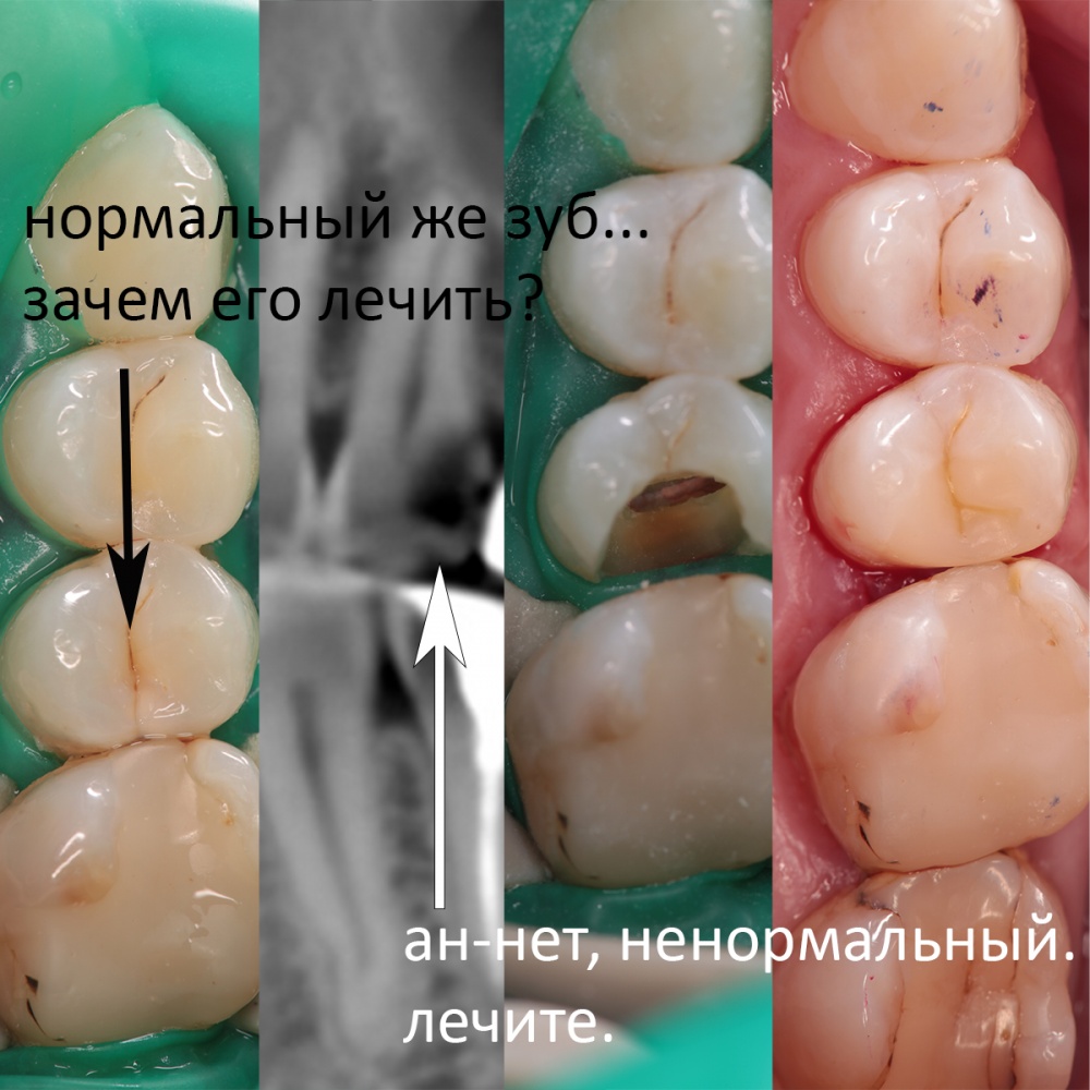 Нормальный зуб же! Зачем его лечить? О диагностике, самодиагностике и профилактических осмотрах