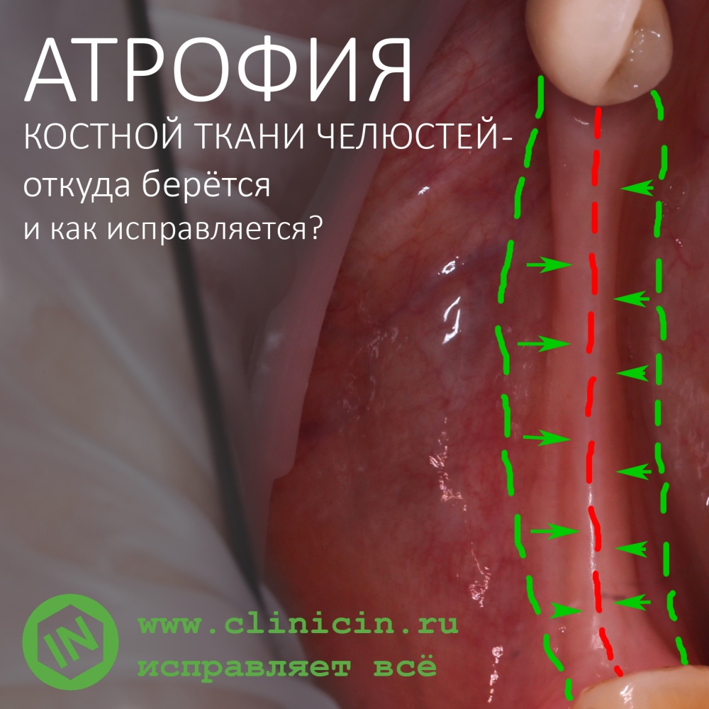 Атрофия костной ткани челюстей — откуда берётся и как исправляется?