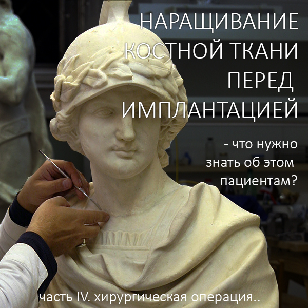 Наращивание костной ткани перед имплантацией — что нужно знать об этом пациентам? Часть IV.
