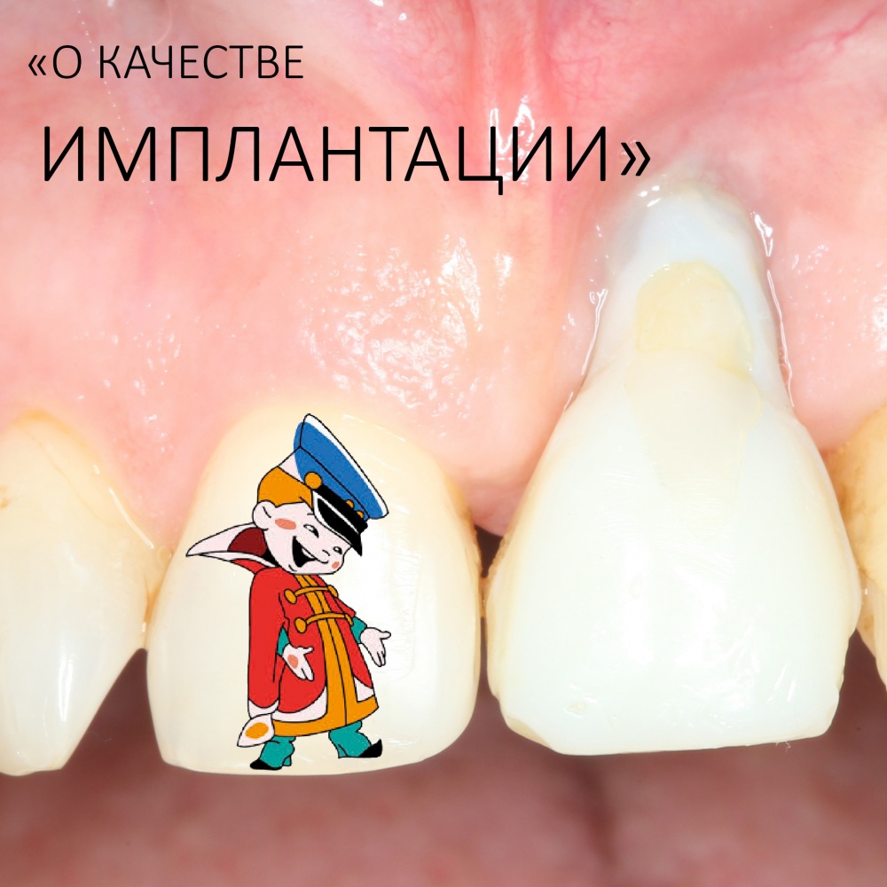 О качестве имплантации.