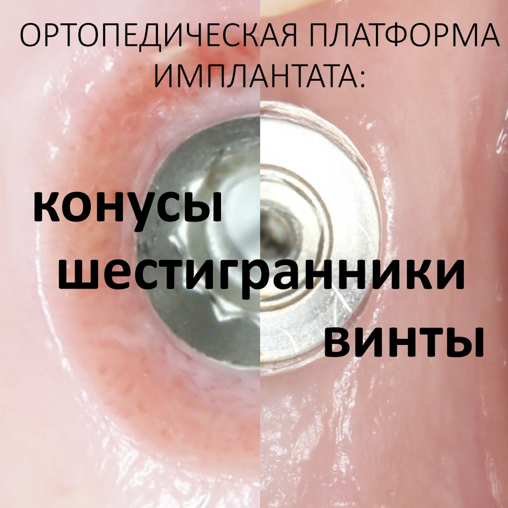 Ортопедическая платформа имплантата: конусы, шестигранники и винты.
