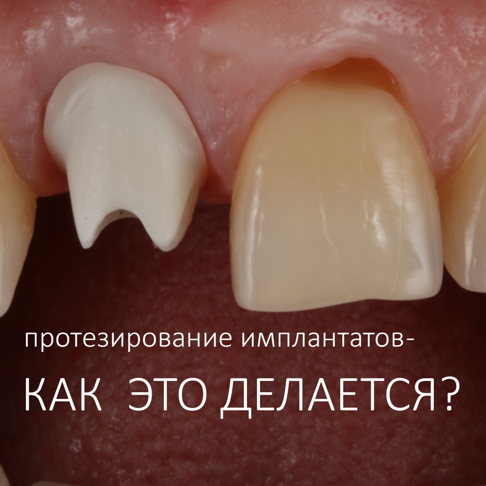 Протезирование с опорой на имплантаты. Как это делается?