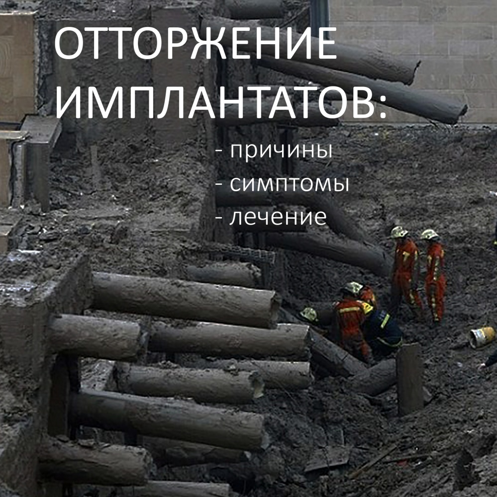 Отторжение имплантатов: причины, симптомы, лечение