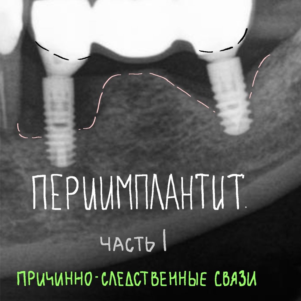 Периимплантит. Часть I. «Причинно-следственные связи».