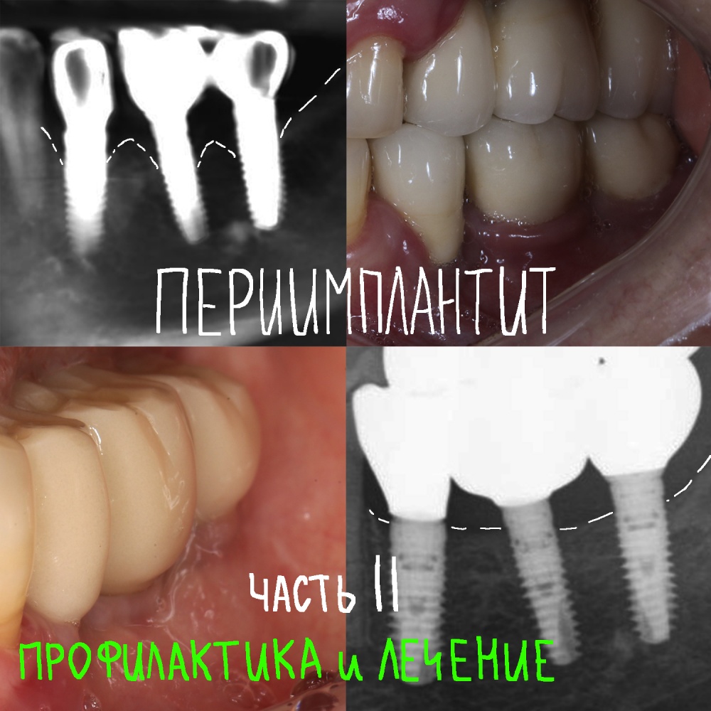 Периимплантит. Часть II: «Профилактика и лечение»