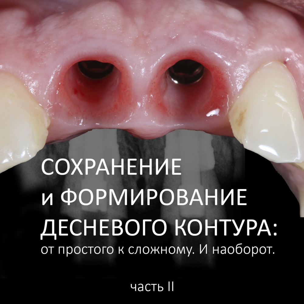 Сохранение и формирование десневого контура: от простого к сложному. И наоборот. ЧАСТЬ II