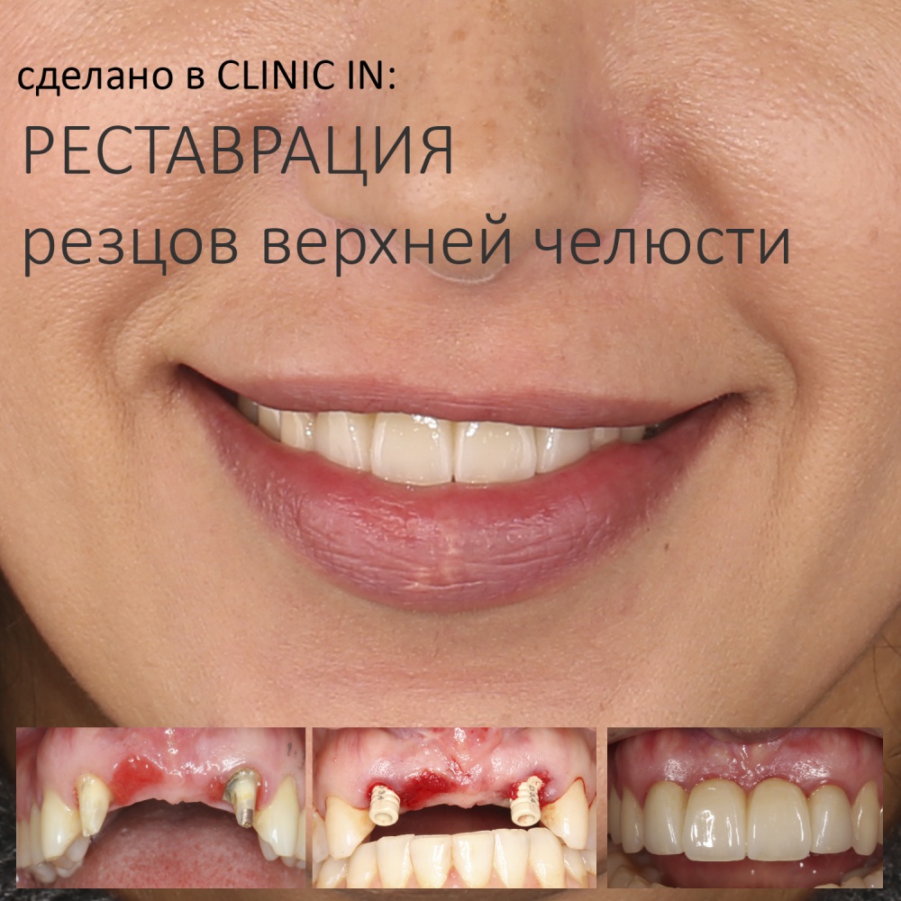 сделано в CLINIC IN: РЕСТАВРАЦИЯ РЕЗЦОВ ВЕРХНЕЙ ЧЕЛЮСТИ