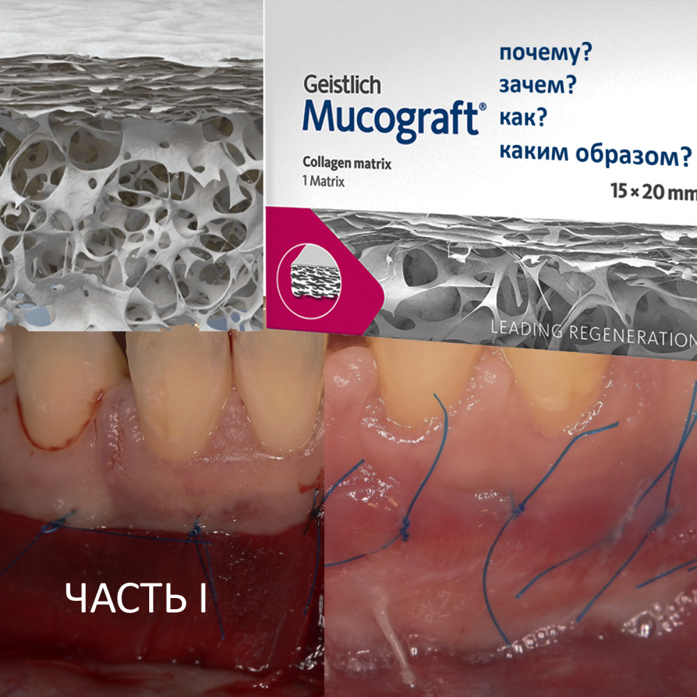 Коллагеновая матрица Geistlich Mucograft — почему, зачем, как и каким образом? Часть I.