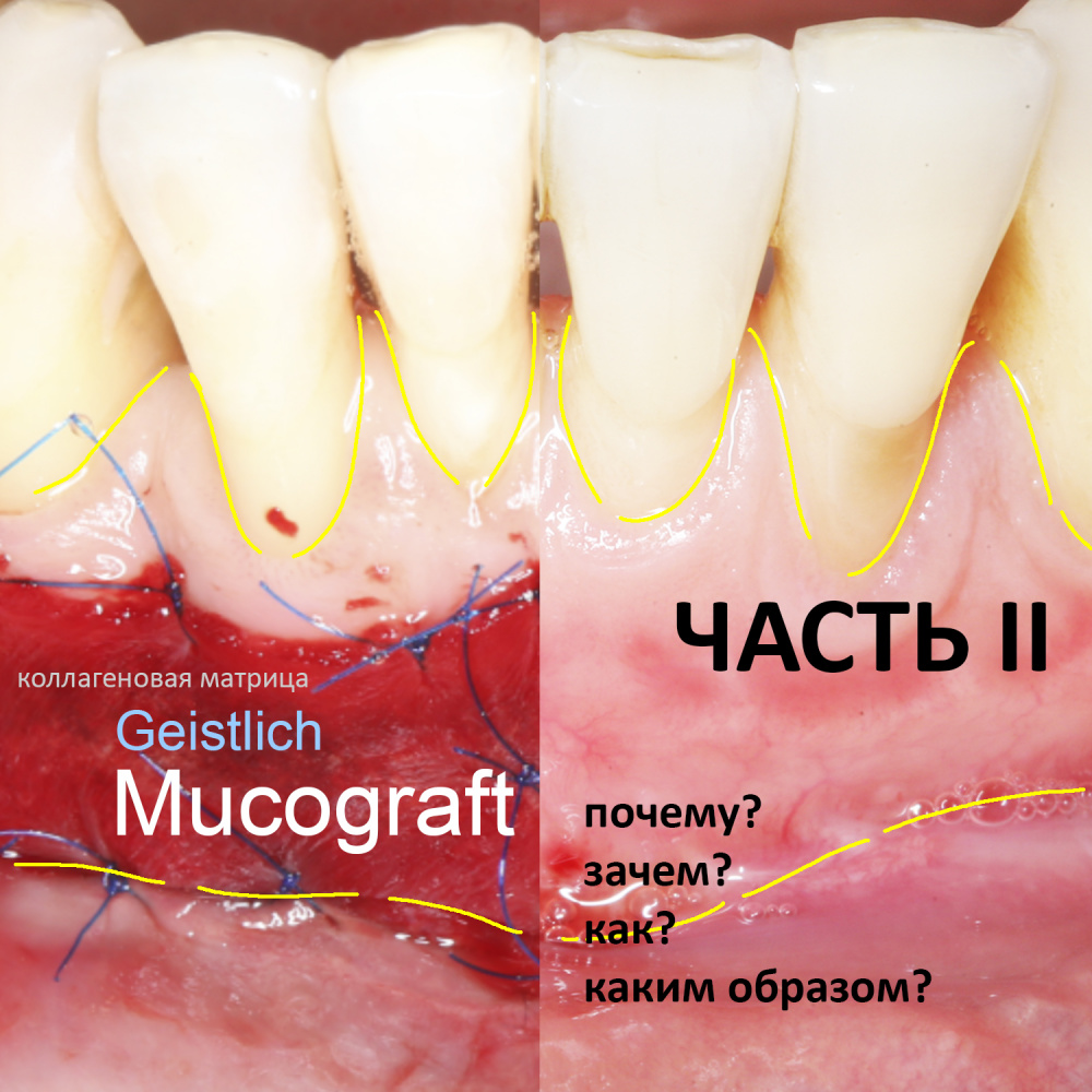 Коллагеновая матрица Geistlich Mucograft — почему, зачем, как и каким образом? Часть II.
