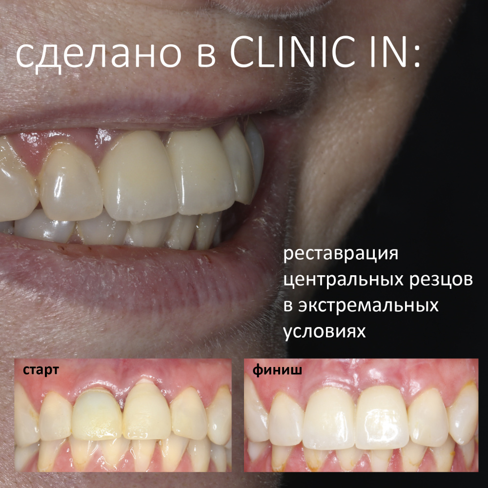 Сделано в CLINIC IN: Реставрация центральных резцов в экстремальных условиях
