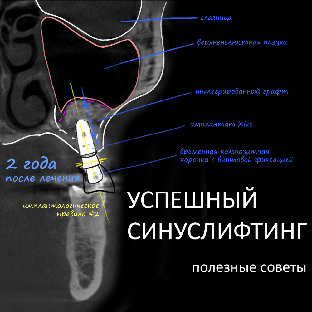 УСПЕШНЫЙ СИНУСЛИФТИНГ: полезные советы