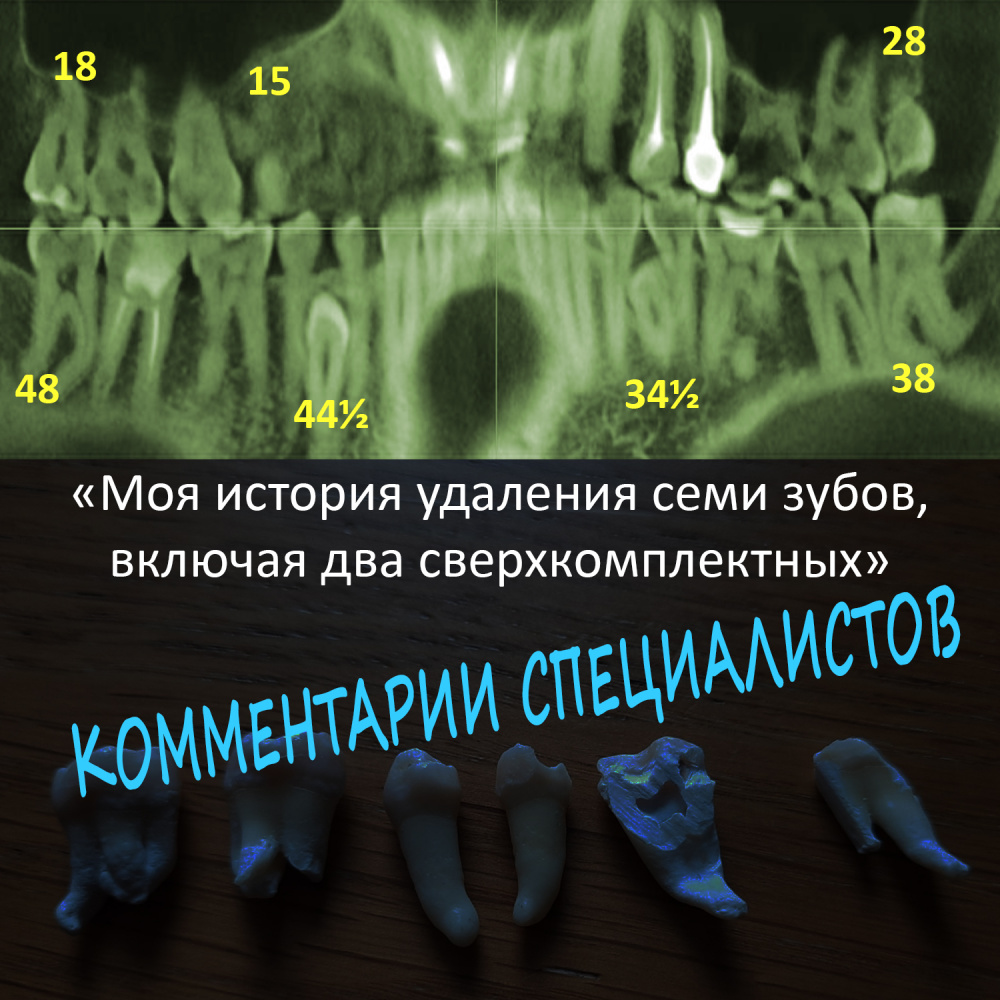 «История удаления семи зубов, включая два сверхкомплектных». Комментарии специалистов.