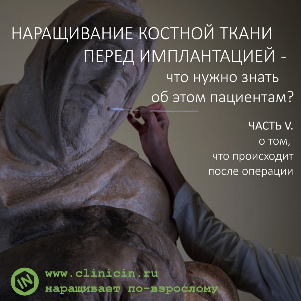 НАРАЩИВАНИЕ КОСТНОЙ ТКАНИ ПЕРЕД ИМПЛАНТАЦИЕЙ — что нужно знать об этом пациентам? ЧАСТЬ V.